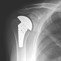 Anatomic Right Shoulder Arthroplasty