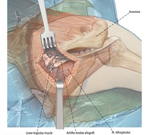 Lower trapezius transfer