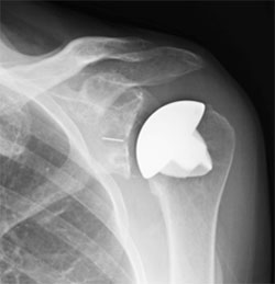 total shoulder replacement