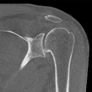 Pyrocarbon hemiarthroplasty