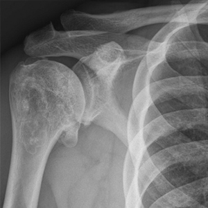 Pyrocarbon hemiarthroplasty