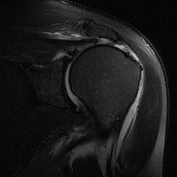 Rotator Cuff Repair