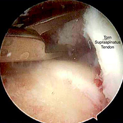 Rotator Cuff Repair