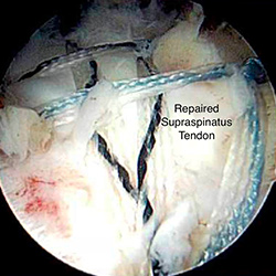 Rotator Cuff Repair