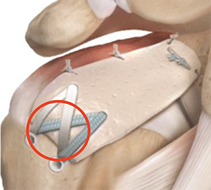 Superior Capsule Reconstruction