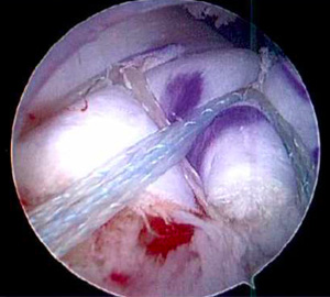 Superior Capsule Reconstruction