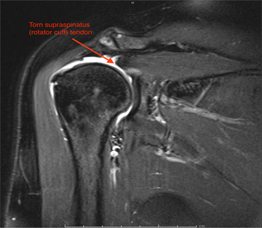 Torn supraspinatus (rotator cuff) tendon