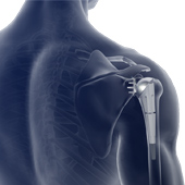 Am I a Candidate for Shoulder Replacement?