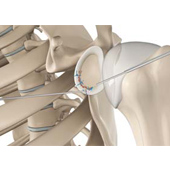 Arthroscopic Bankart Repair