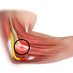 Common Extensor Tendon Origin Repair