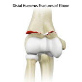 Distal Humerus Fractures of the Elbow