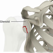 Glenoid Fractures