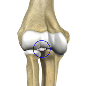 Loose Bodies in the Elbow