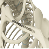 ORIF of the Clavicle Fractures