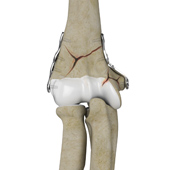 ORIF of the Distal Humerus Fractures
