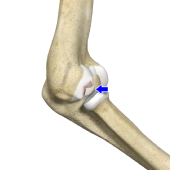 Osteochondritis Dissecans of Elbow