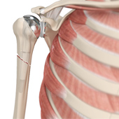 Periprosthetic Shoulder Fracture