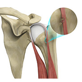 Proximal Biceps Tendon Rupture