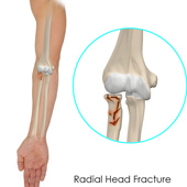 Radial Head Fractures of the Elbow