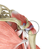 Rotator Cuff Pain