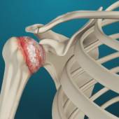 Arthritis of the Shoulder