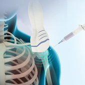 Ultrasound-Guided Shoulder Injections